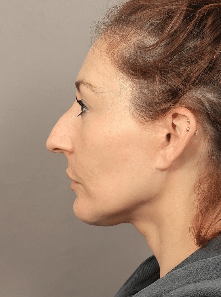 Blepharoplasty Before & After