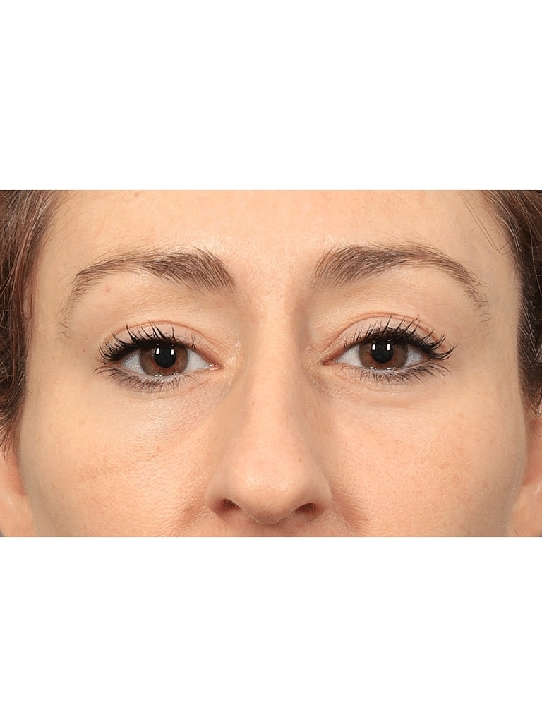 Blepharoplasty Before & After