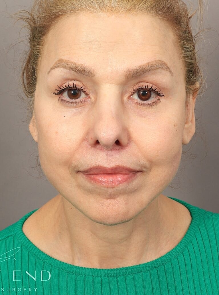 Blepharoplasty Before & After