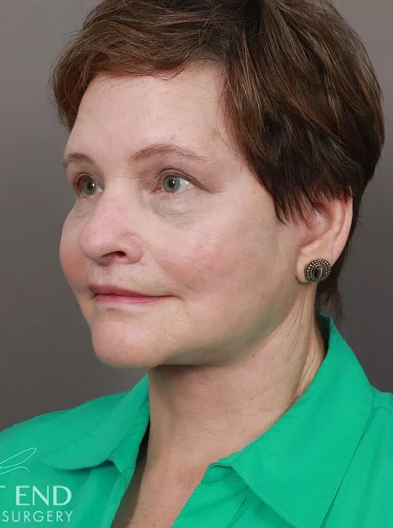 Blepharoplasty Before & After