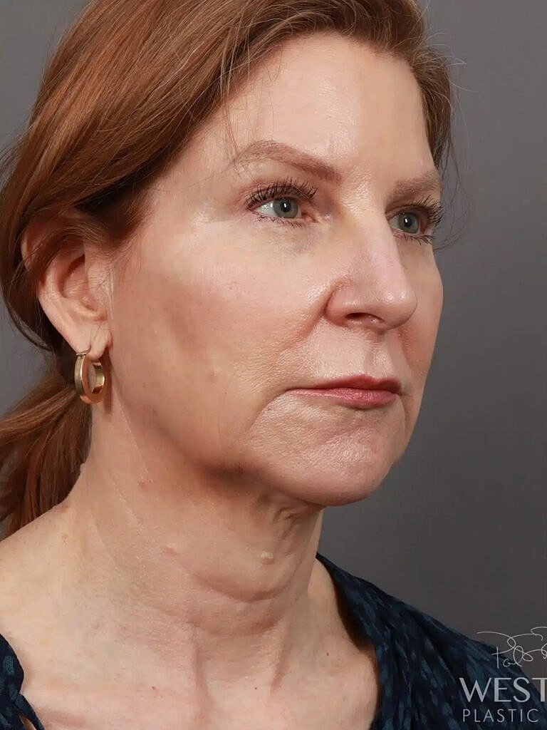 Blepharoplasty Before & After