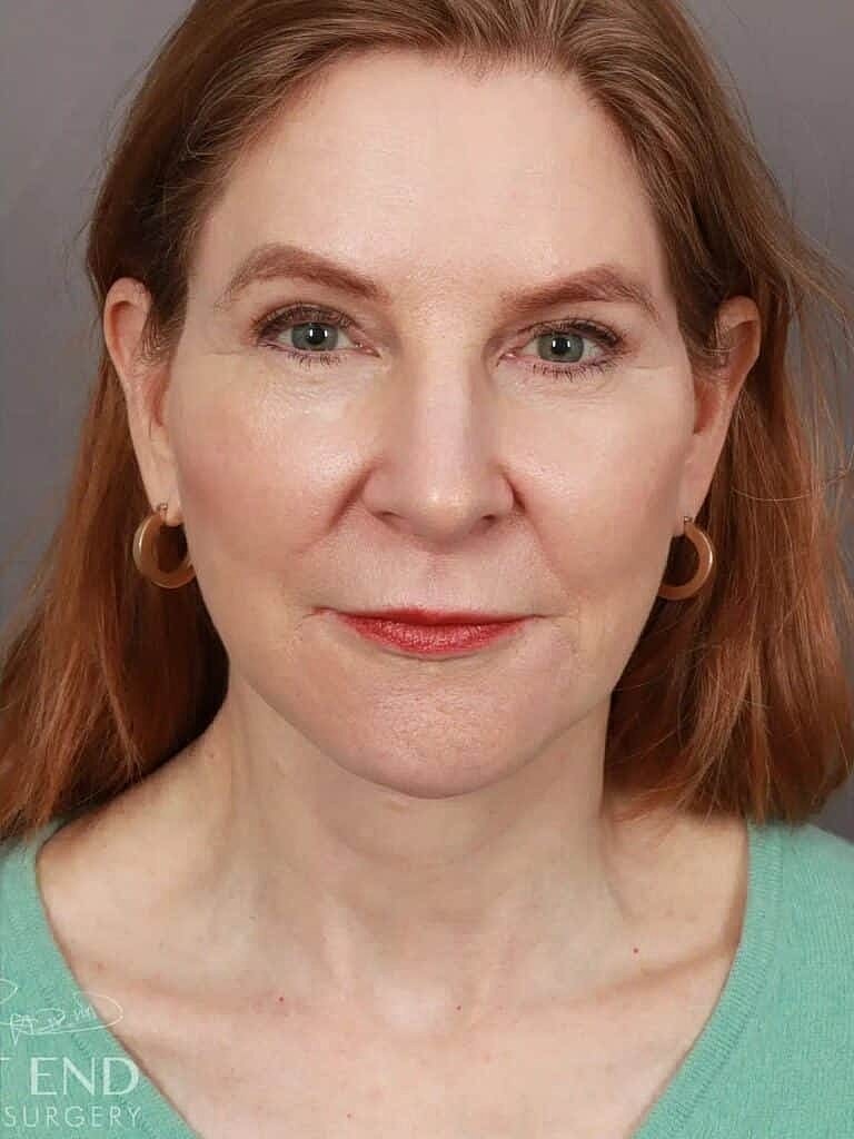 Blepharoplasty Before & After