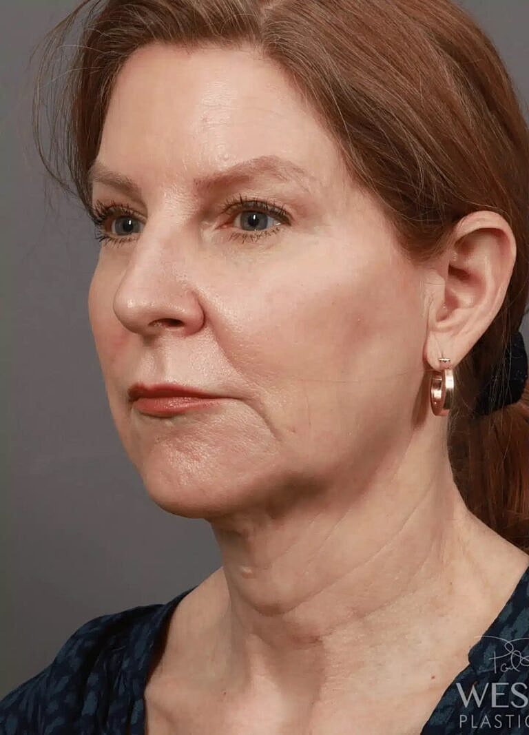 Blepharoplasty Before & After