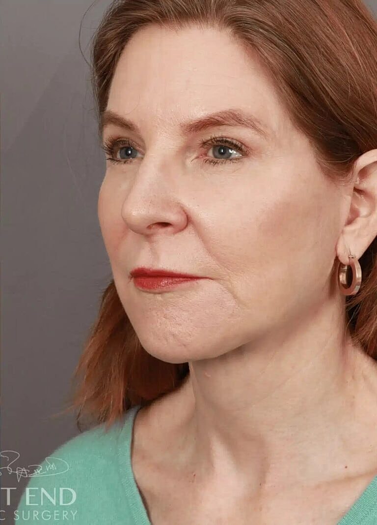 Blepharoplasty Before & After