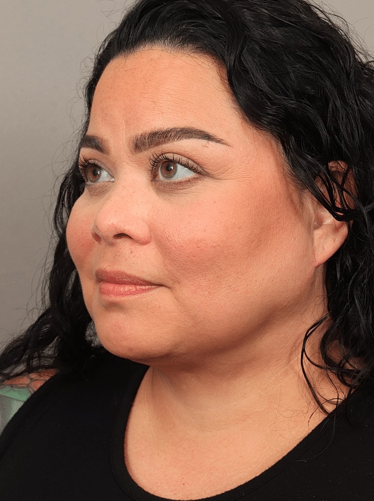 Blepharoplasty Before & After