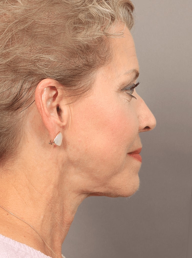 Blepharoplasty Before & After