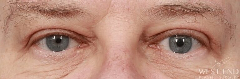 Blepharoplasty Before & After