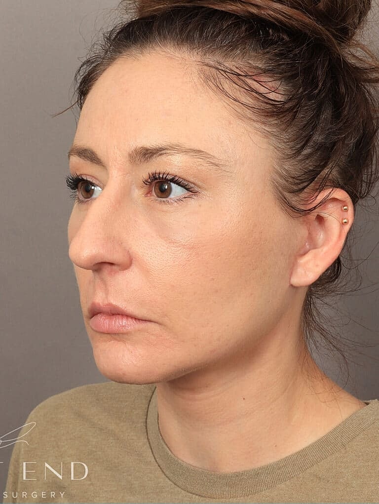 Blepharoplasty Before & After