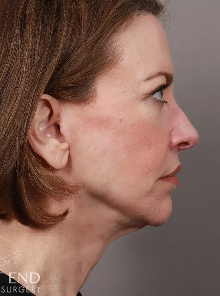 Blepharoplasty Before & After