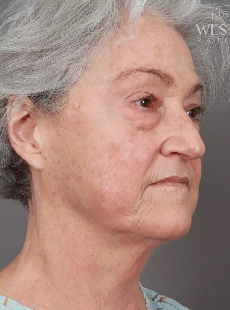 Blepharoplasty Before & After