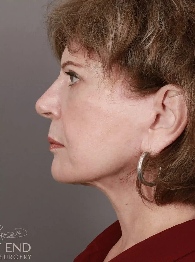 Blepharoplasty Before & After