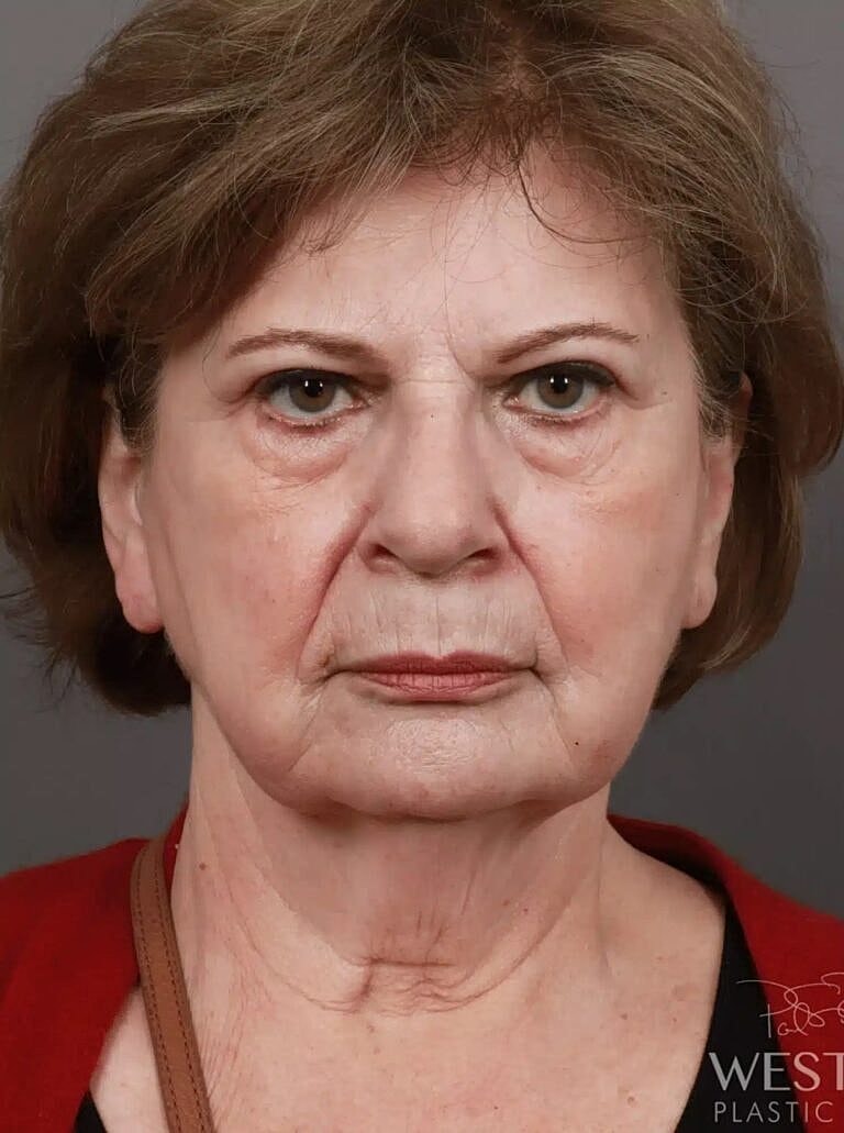 Blepharoplasty Before & After