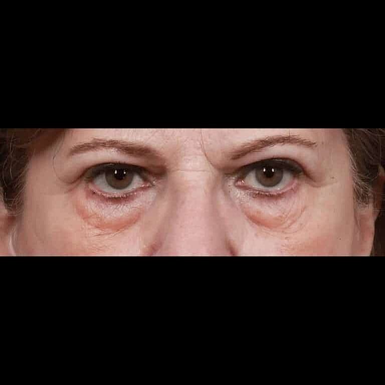 Blepharoplasty Before & After