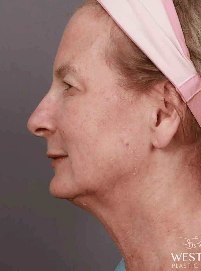Blepharoplasty Before & After