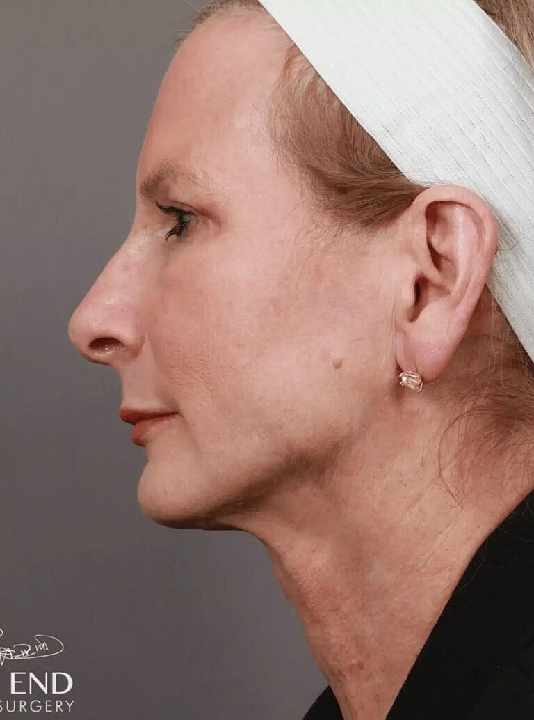 Blepharoplasty Before & After