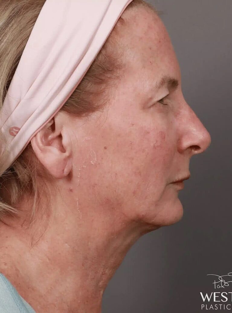 Blepharoplasty Before & After