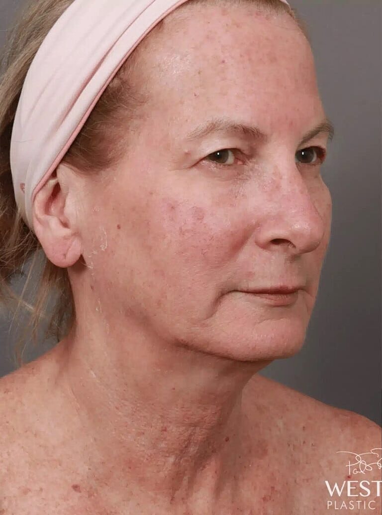 Blepharoplasty Before & After
