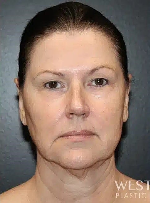 Blepharoplasty Before & After