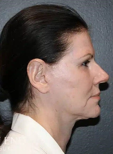 Blepharoplasty Before & After