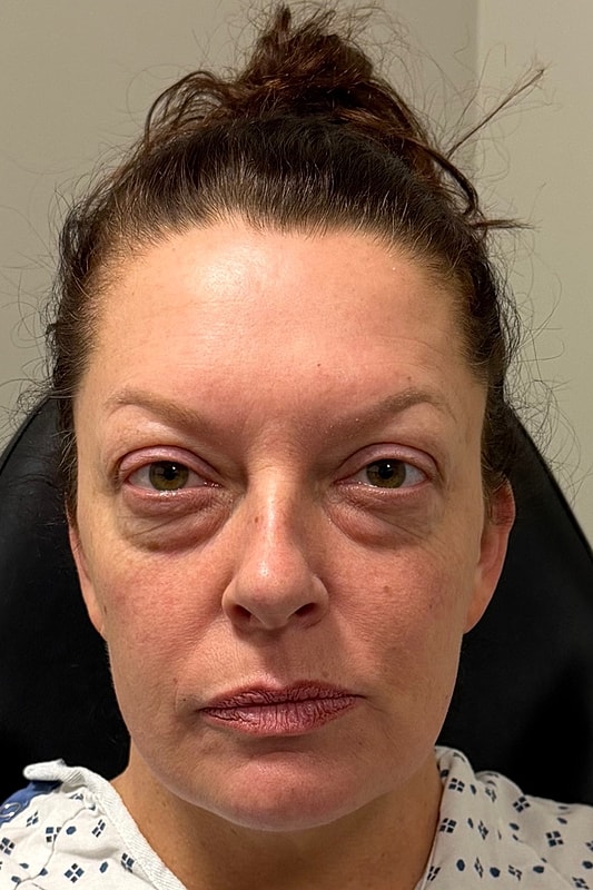 Blepharoplasty Before & After