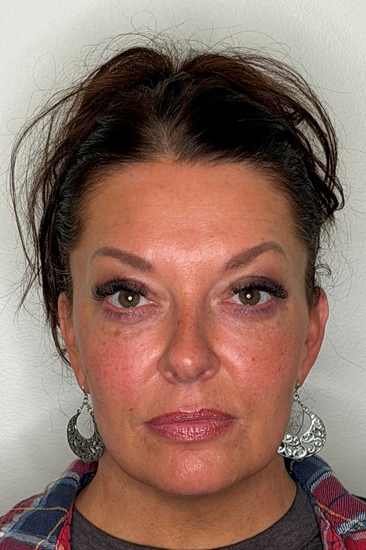 Blepharoplasty Before & After
