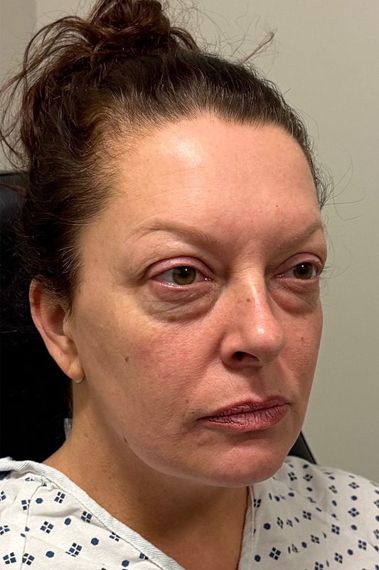 Blepharoplasty Before & After