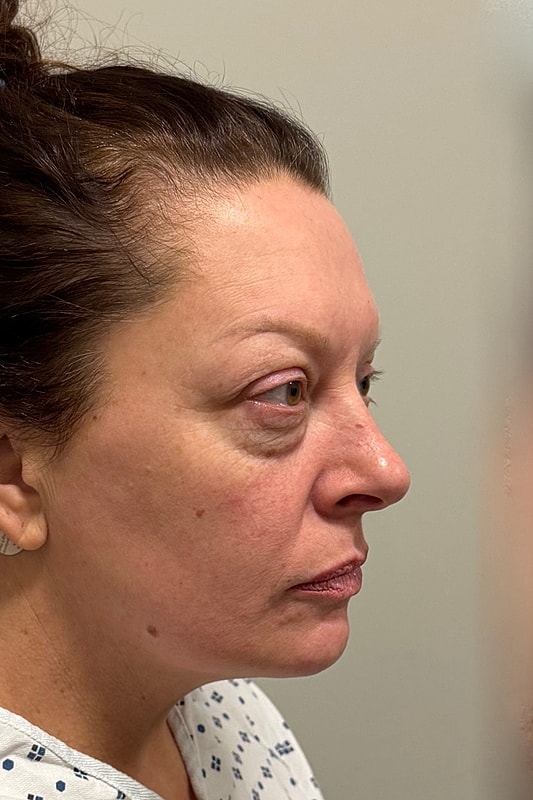 Blepharoplasty Before & After