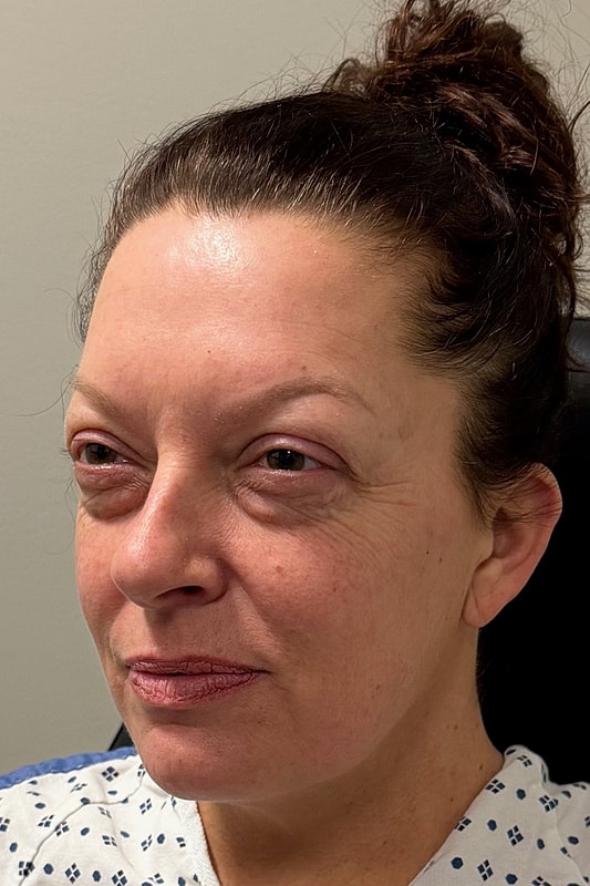 Blepharoplasty Before & After