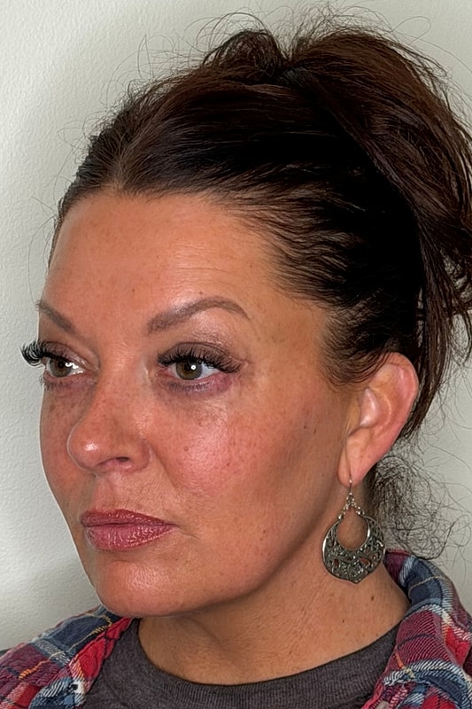 Blepharoplasty Before & After