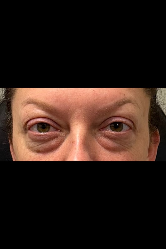 Blepharoplasty Before & After