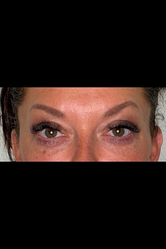 Blepharoplasty Before & After