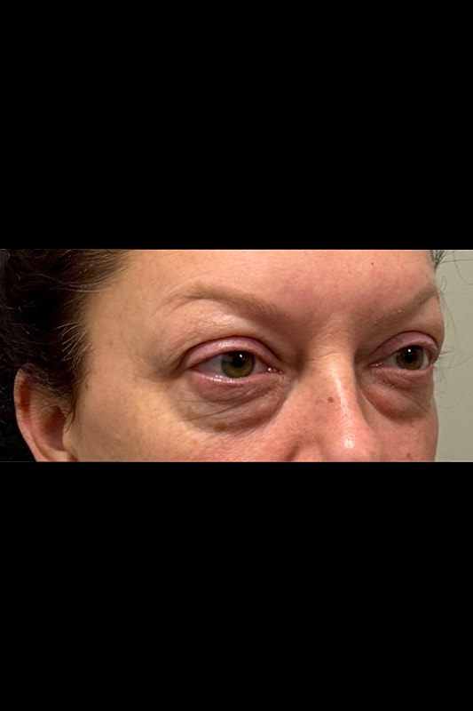 Blepharoplasty Before & After