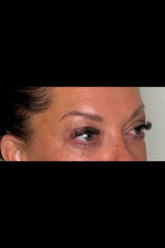 Blepharoplasty Before & After