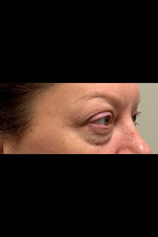 Blepharoplasty Before & After
