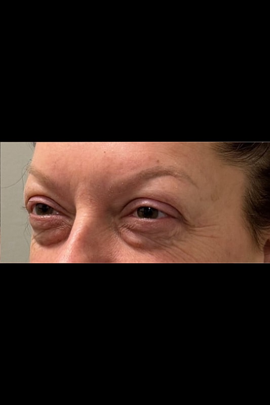 Blepharoplasty Before & After