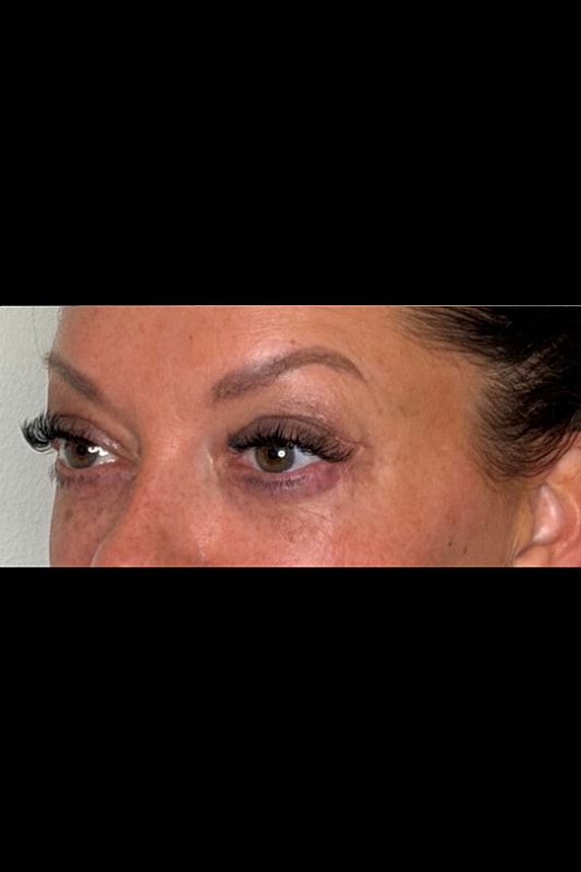 Blepharoplasty Before & After