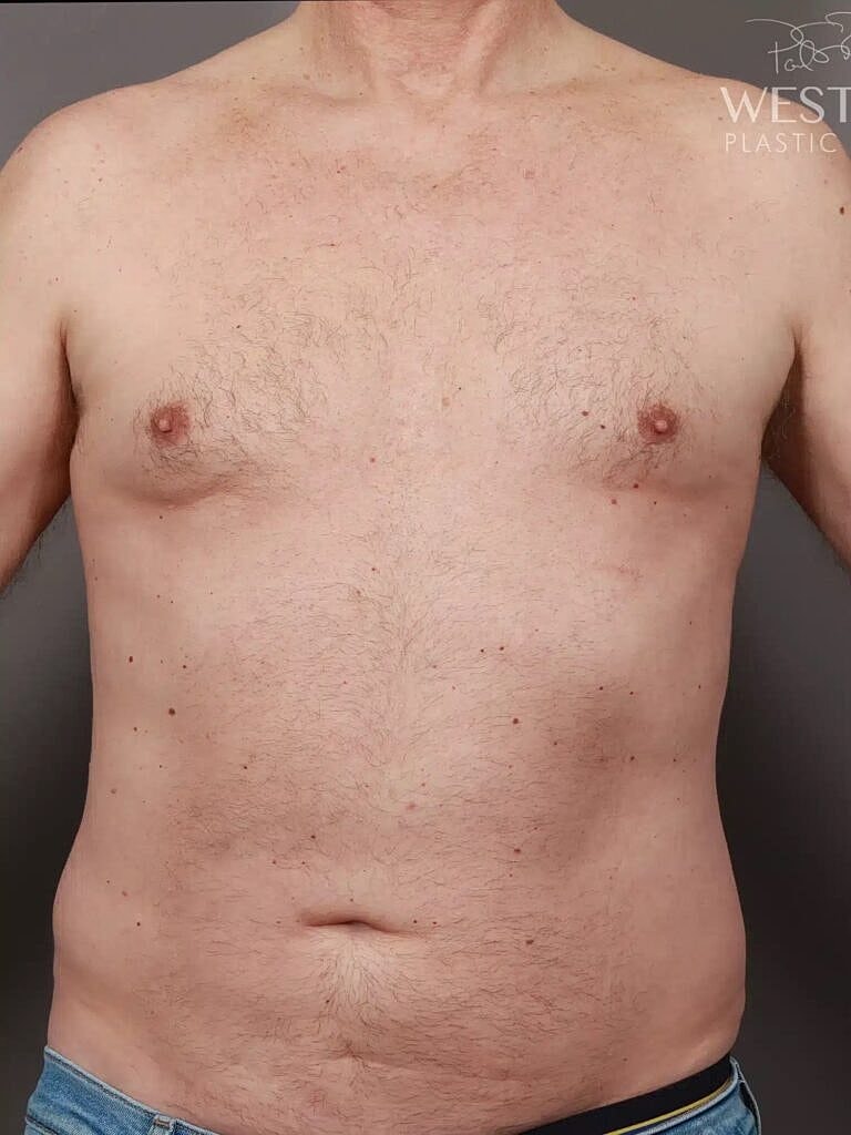 Pectoral Implants Before & After