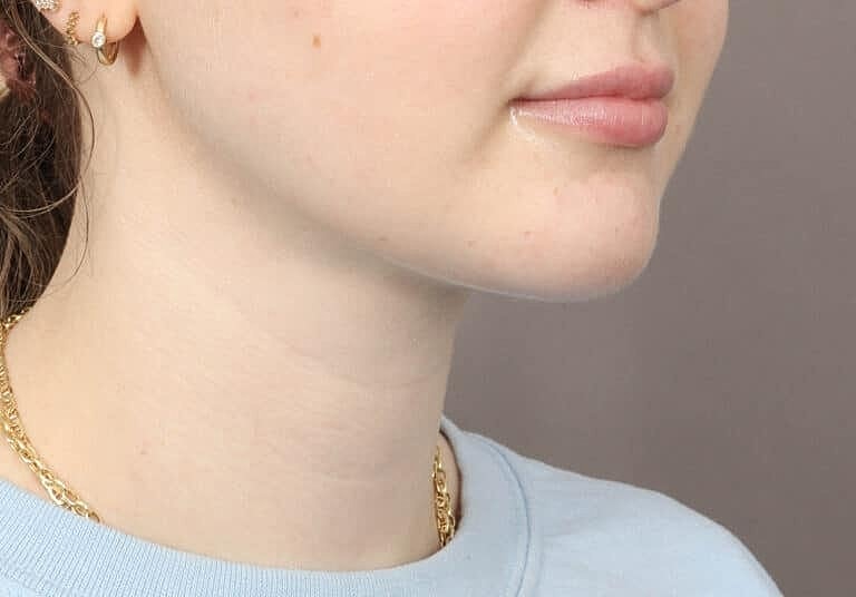 Face Liposuction Before & After