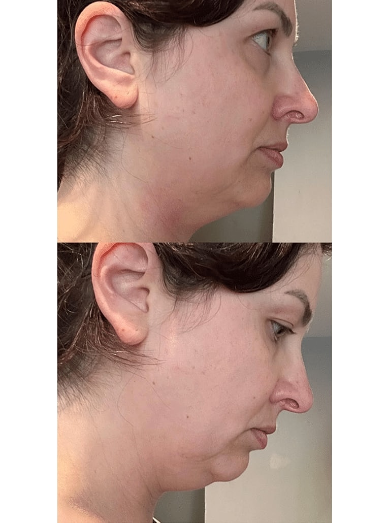 Face Liposuction Before & After