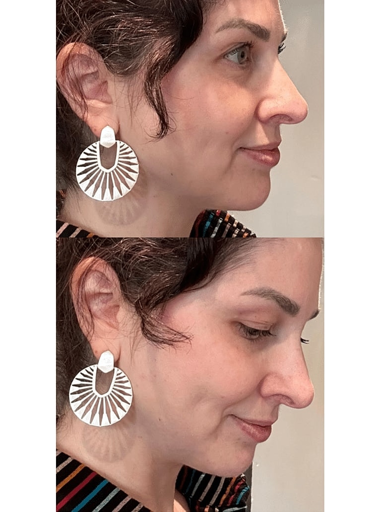 Face Liposuction Before & After