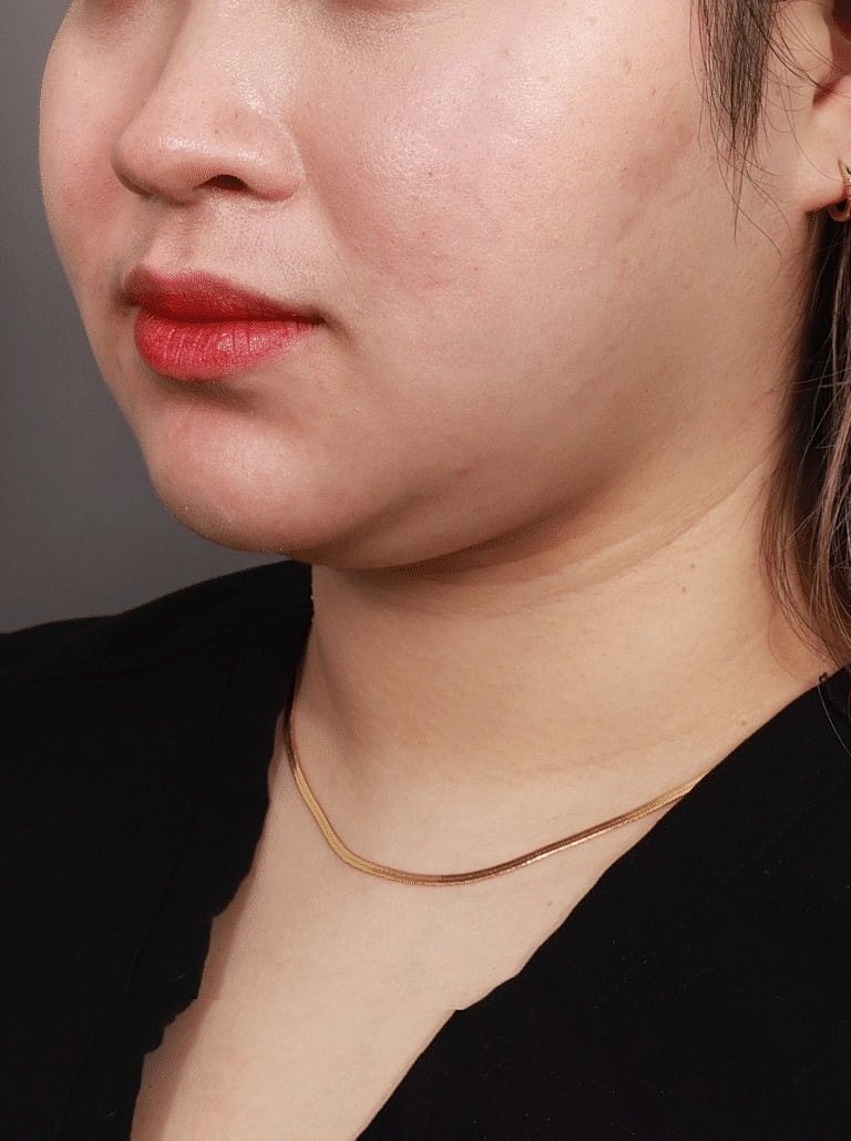 Face Liposuction Before & After