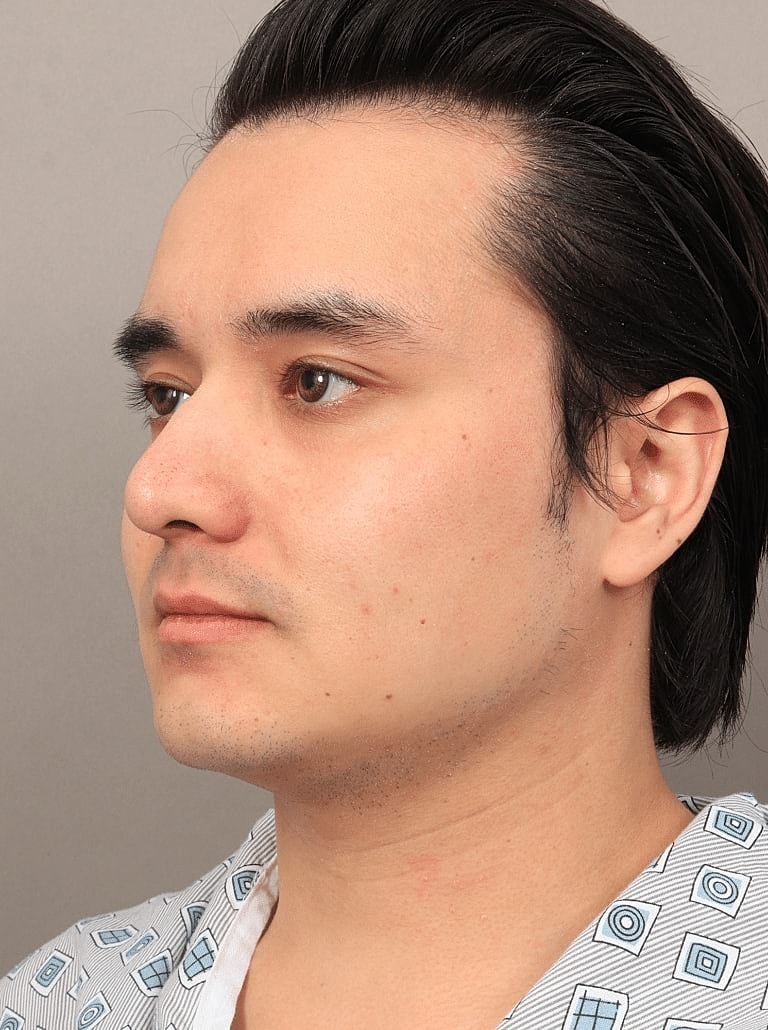 Face Liposuction Before & After