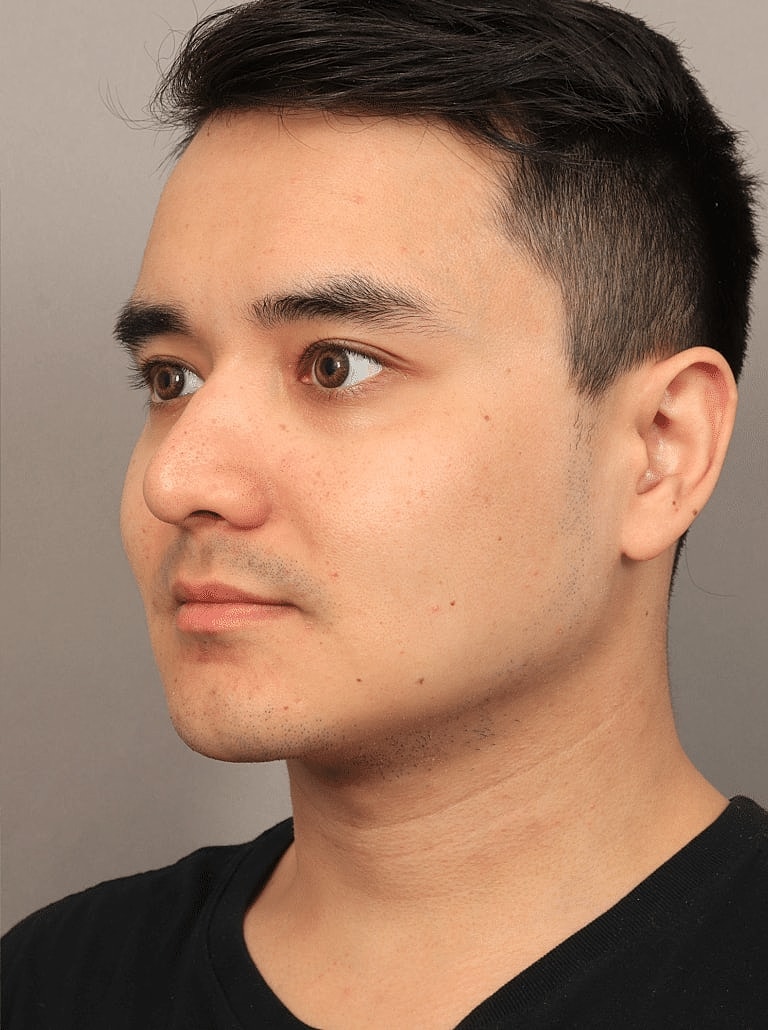 Face Liposuction Before & After