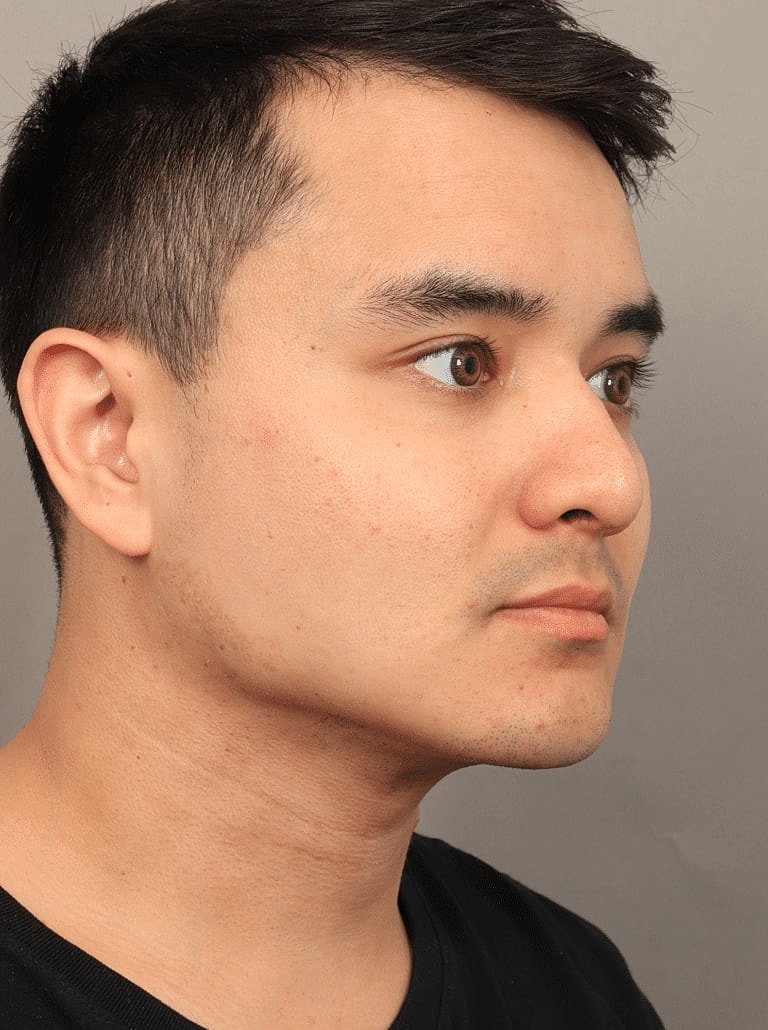 Face Liposuction Before & After