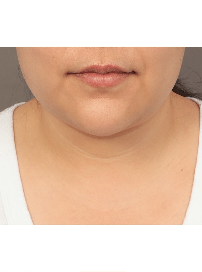Face Liposuction Before & After