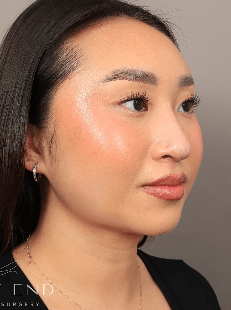 Face Liposuction Before & After