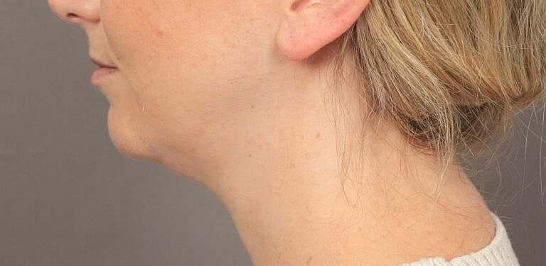 Face Liposuction Before & After