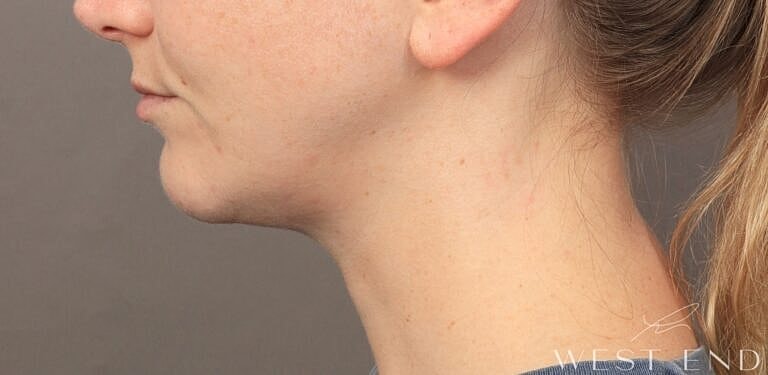 Face Liposuction Before & After