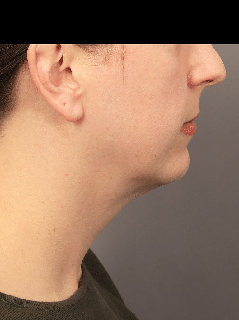 Face Liposuction Before & After