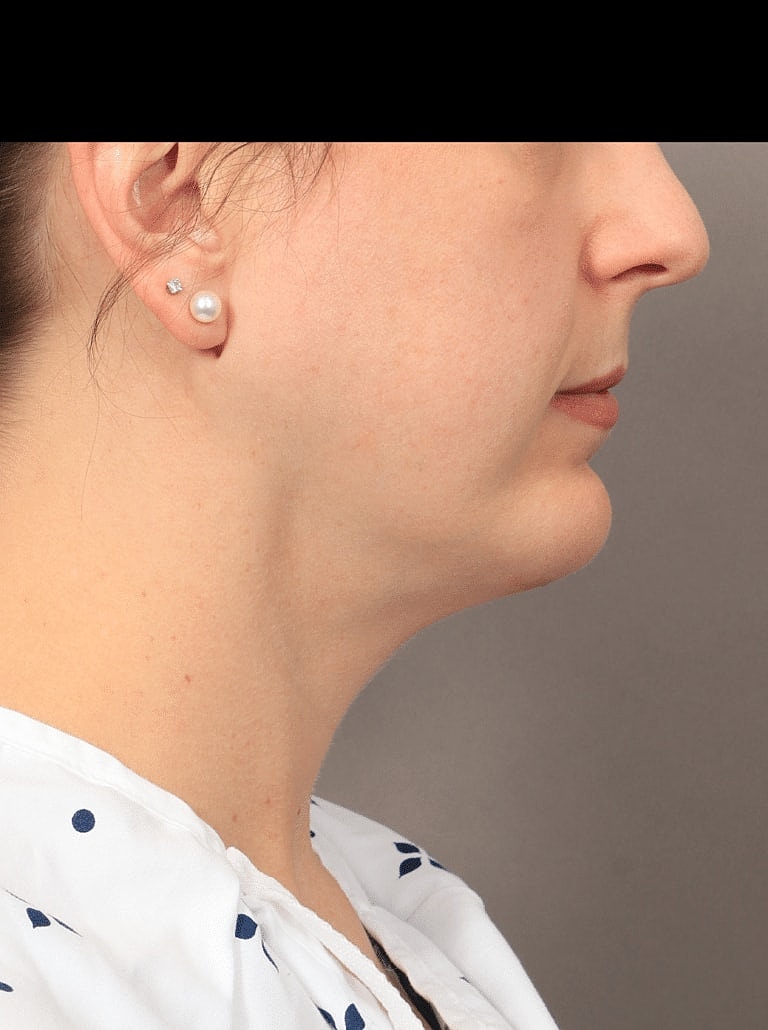 Face Liposuction Before & After
